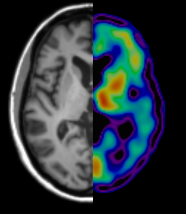 Researching FTD through Imaging and Blood Tests
